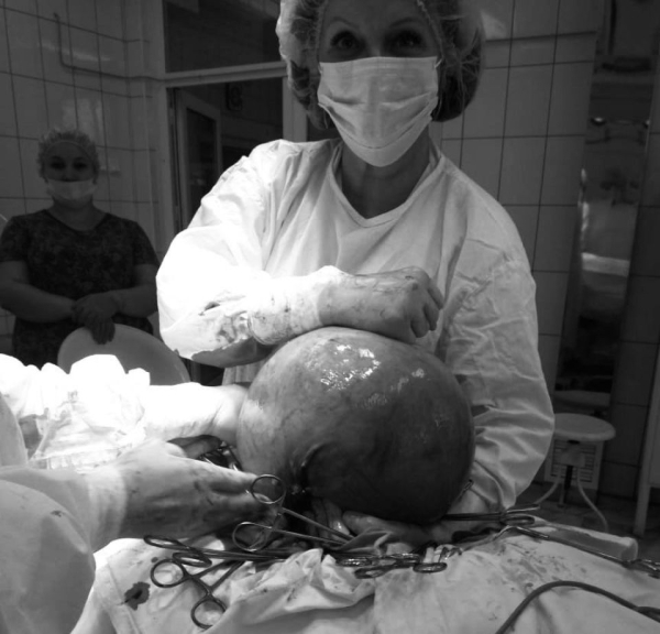 Кисту размером с футбольный мяч удалили алтайские гинекологи