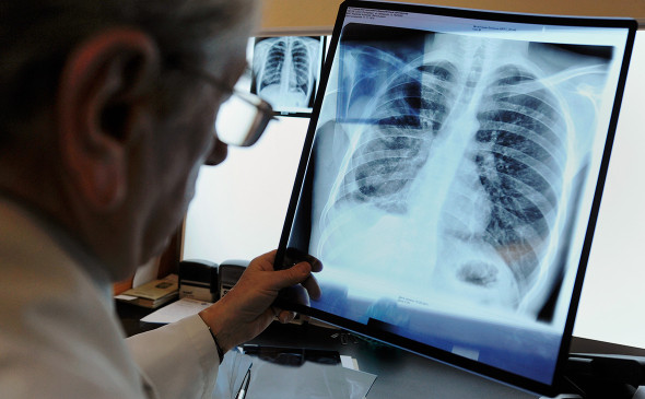 В Роспотребнадзоре рассказали о заболеваемости туберкулезом в регионе